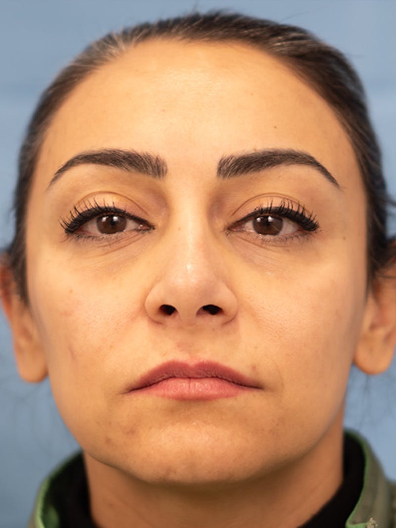 Rhinoplasty Before & After Gallery - Patient 253709 - Image 4