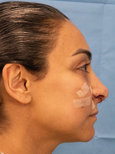 Rhinoplasty Before & After Gallery - Patient 253709 - Image 1