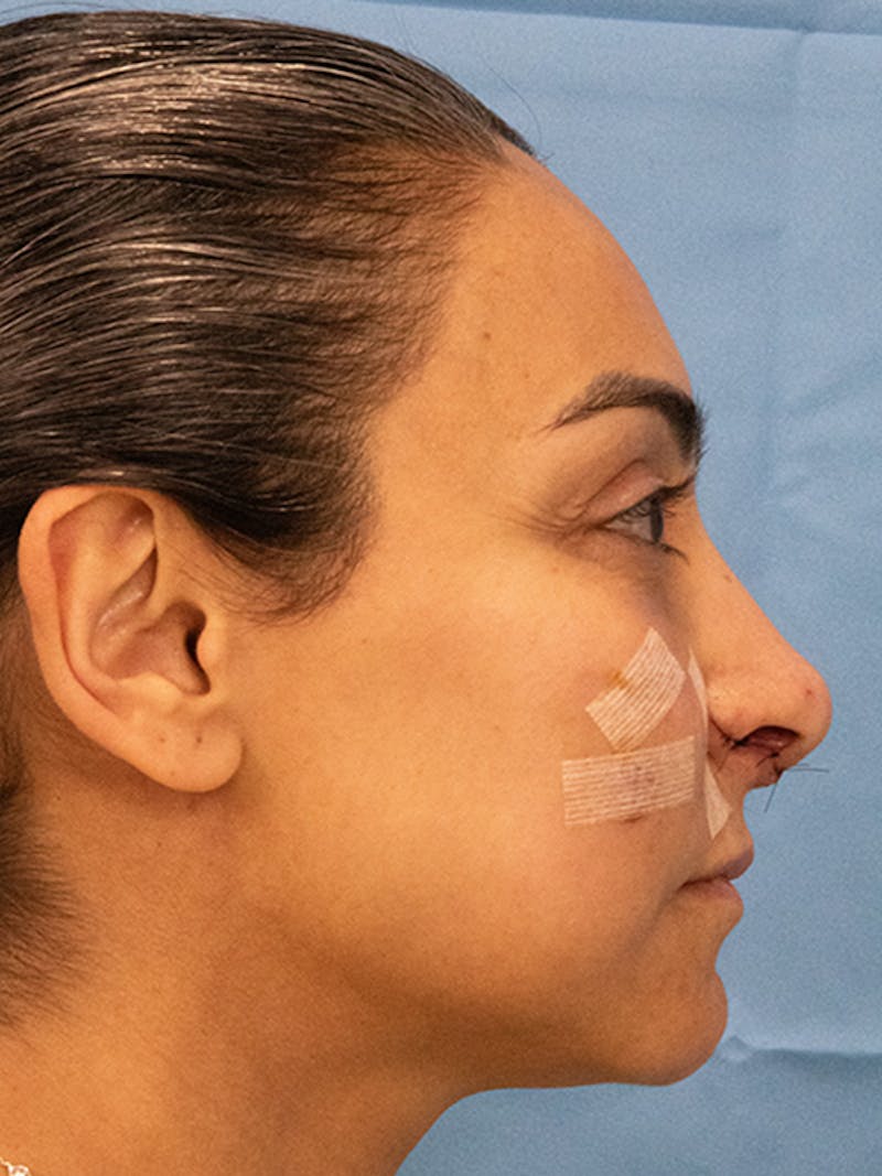 Rhinoplasty Before & After Gallery - Patient 253709 - Image 1