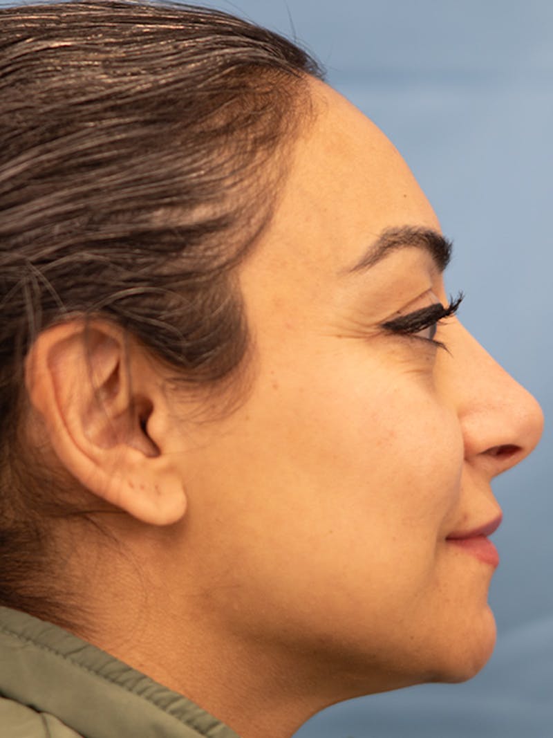 Rhinoplasty Before & After Gallery - Patient 253709 - Image 2