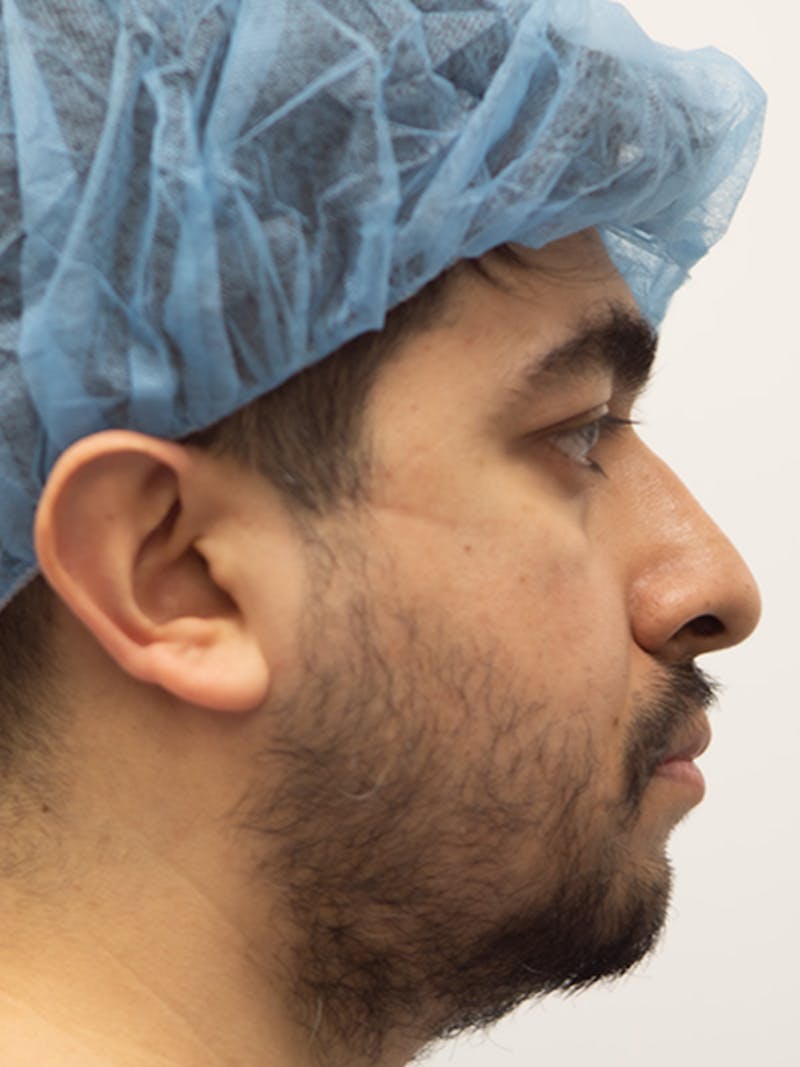 Rhinoplasty Before & After Gallery - Patient 207061 - Image 1