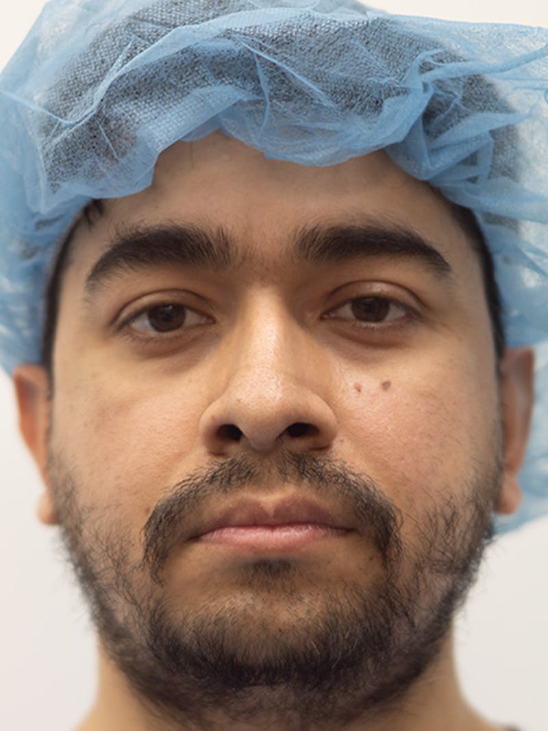 Rhinoplasty Before & After Gallery - Patient 207061 - Image 3