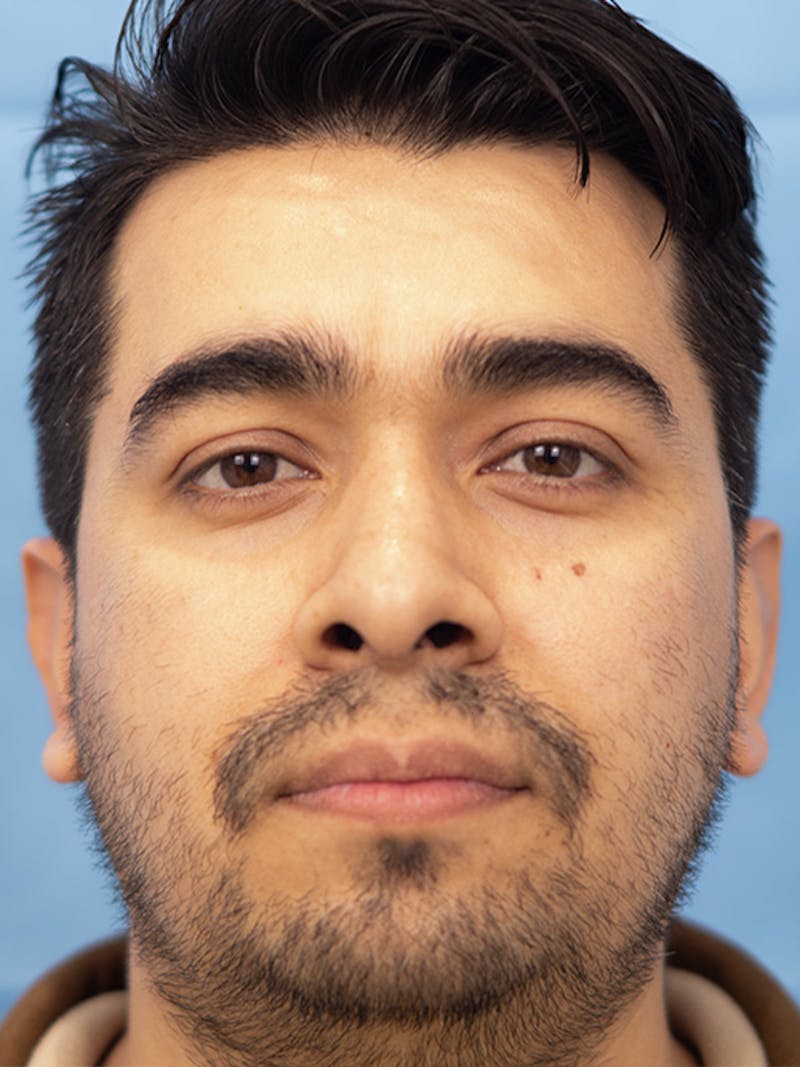 Rhinoplasty Before & After Gallery - Patient 207061 - Image 4