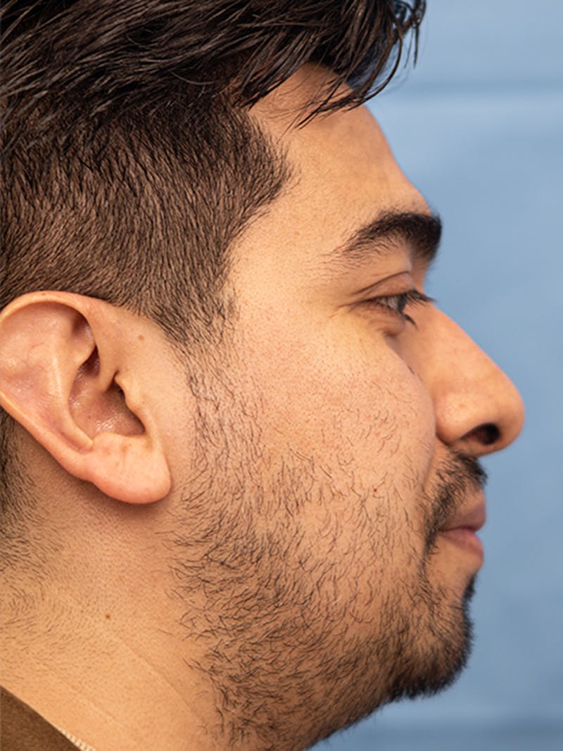 Rhinoplasty Before & After Gallery - Patient 207061 - Image 2