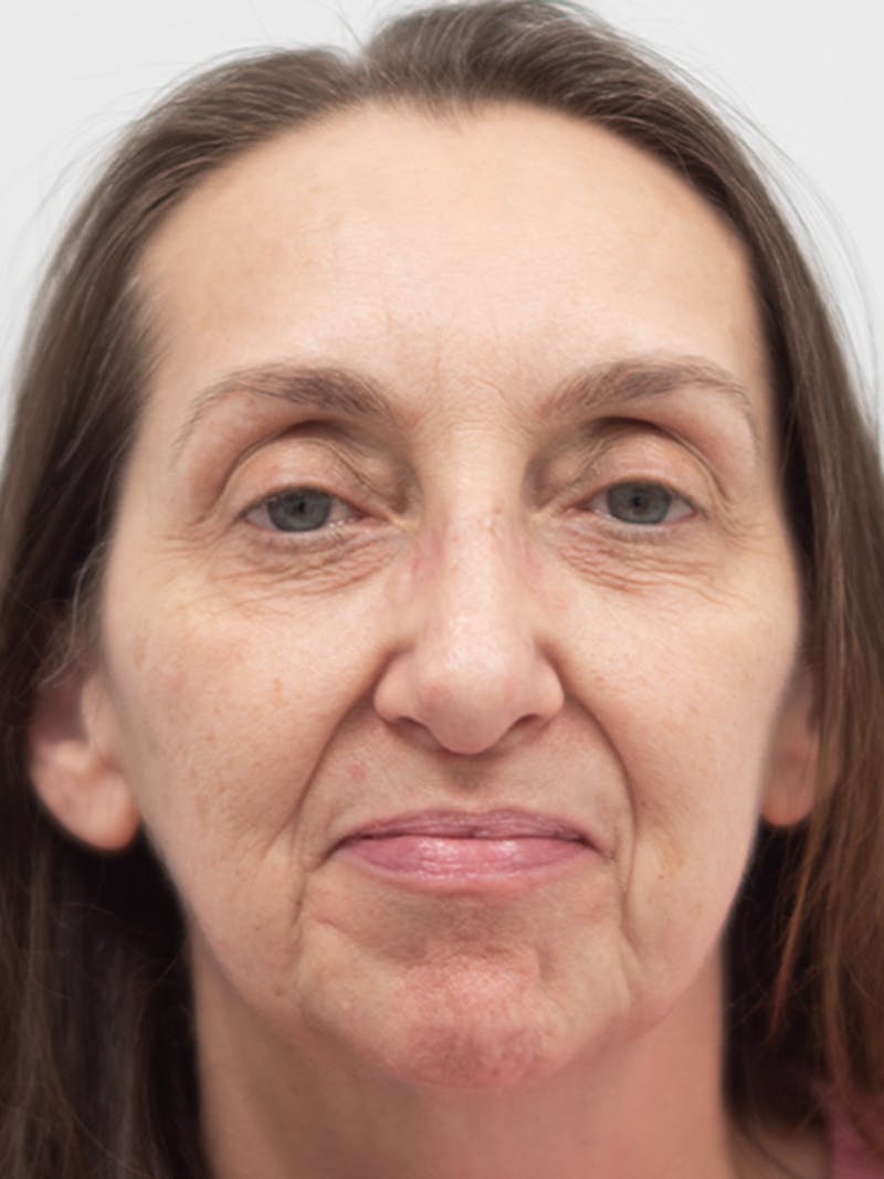 Rhinoplasty Before & After Gallery - Patient 218730 - Image 4