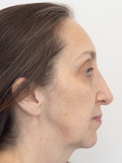 Rhinoplasty Before & After Gallery - Patient 218730 - Image 1