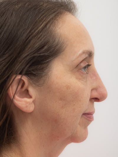 Rhinoplasty Before & After Gallery - Patient 218730 - Image 2