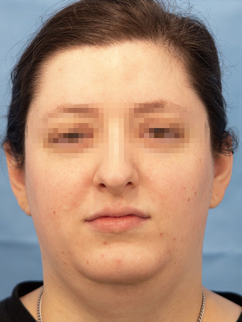 Submental Liposuction Before & After Gallery - Patient 124794 - Image 4