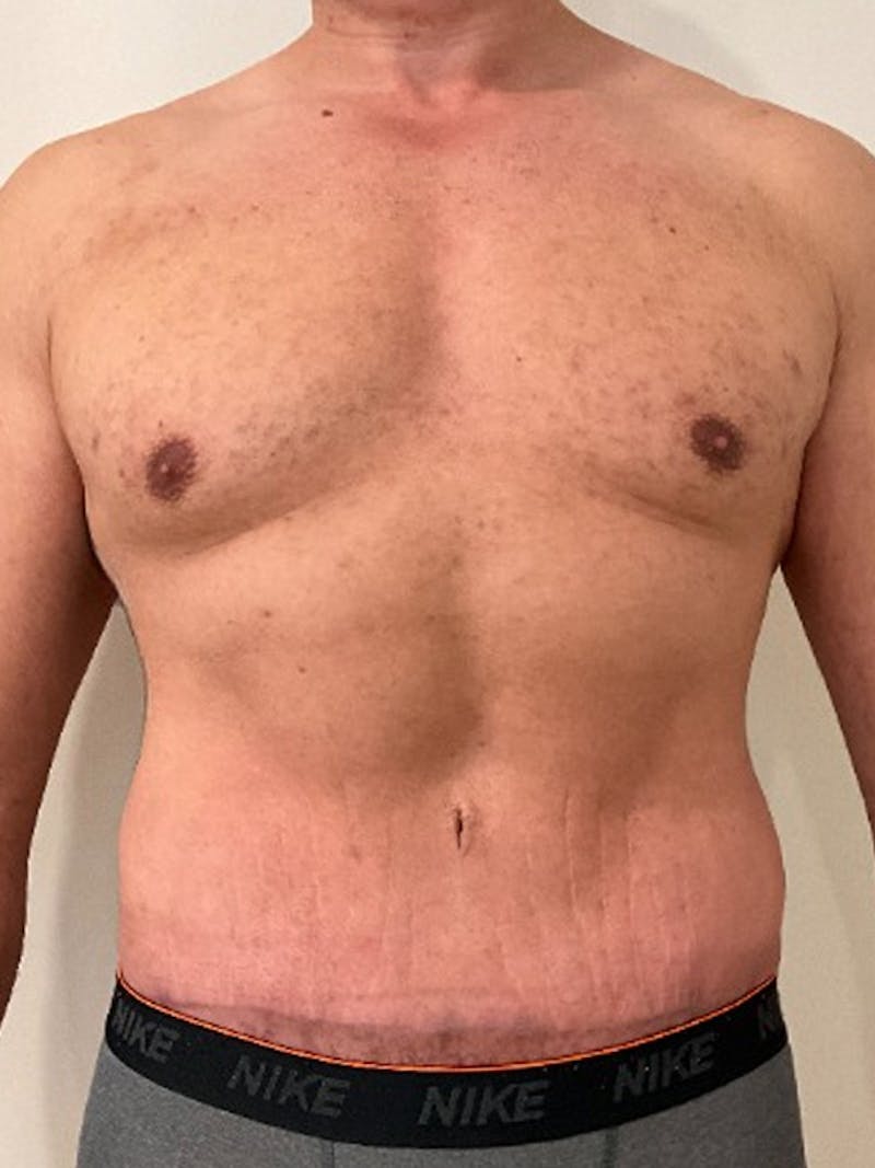 Tummy Tuck Before & After Gallery - Patient 192850 - Image 2