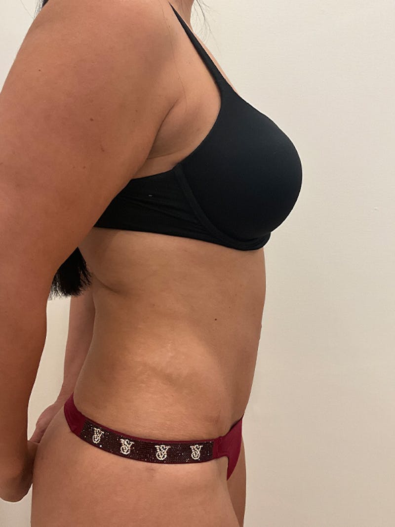 Tummy Tuck Before & After Gallery - Patient 314712 - Image 6