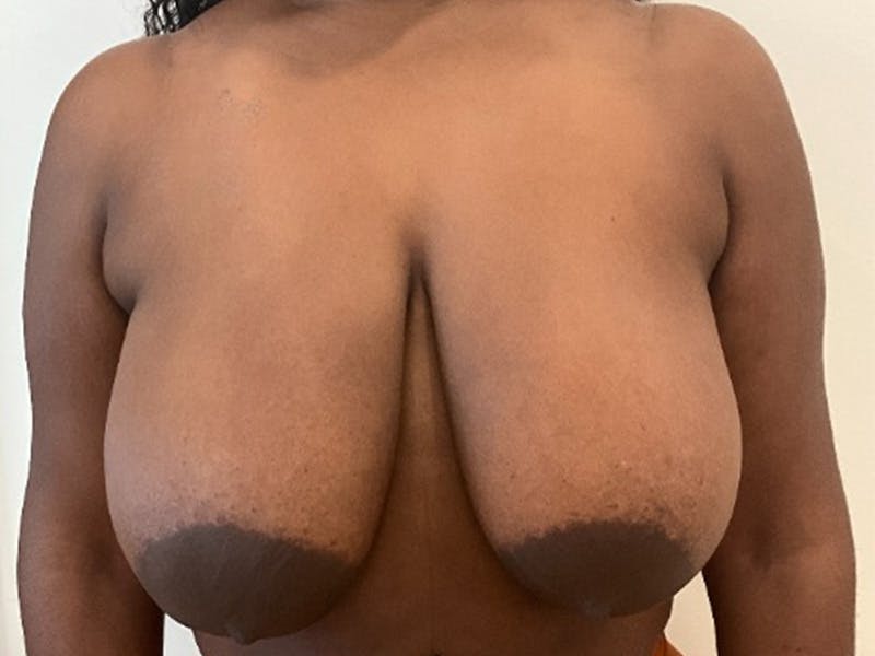 Liposuction Before & After Gallery - Patient 265816 - Image 1