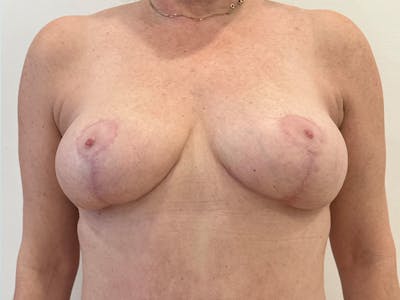 Breast Lift Before & After Gallery - Patient 159915 - Image 2