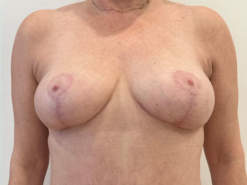 Breast Lift Before & After Gallery - Patient 159915 - Image 2