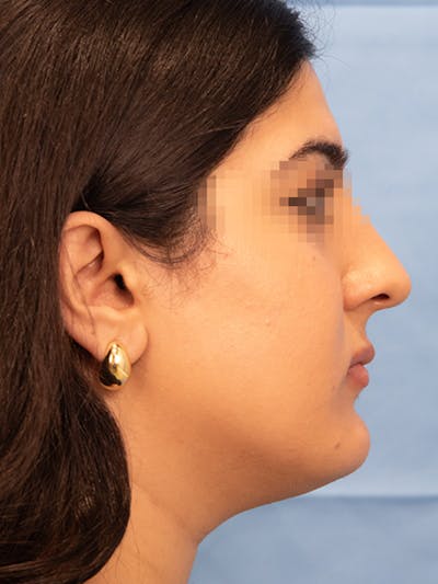 Submental Liposuction Before & After Gallery - Patient 336163 - Image 1