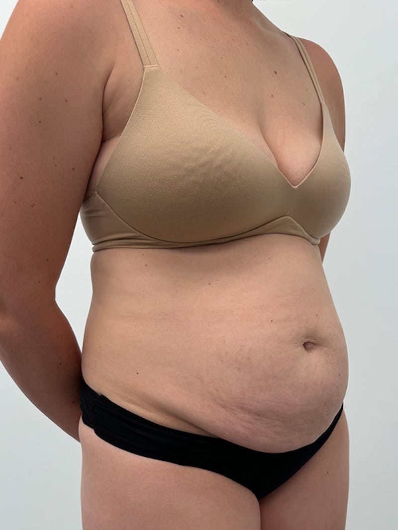 Tummy Tuck Before & After Gallery - Patient 138891 - Image 3