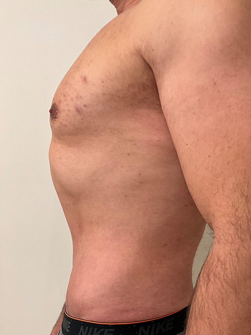 Tummy Tuck Before & After Gallery - Patient 192850 - Image 6