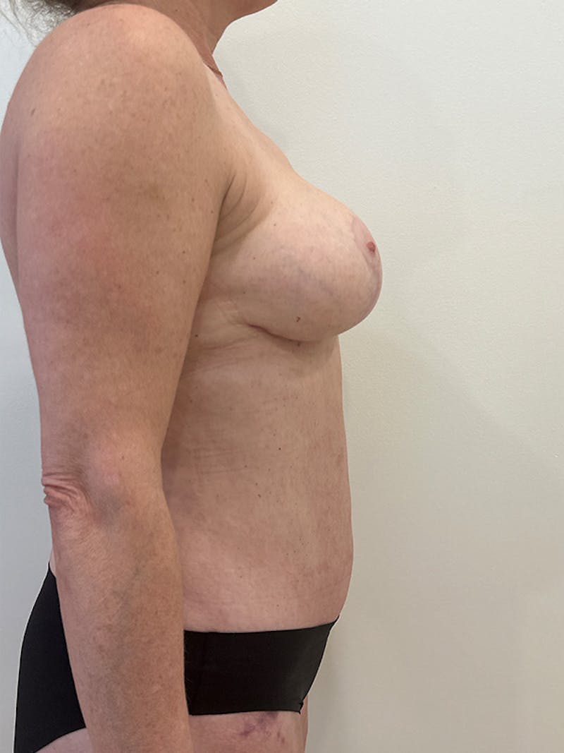 Tummy Tuck Before & After Gallery - Patient 162522 - Image 6