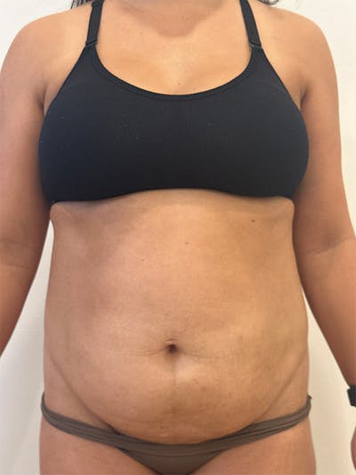 Tummy Tuck Before & After Gallery - Patient 174567 - Image 1