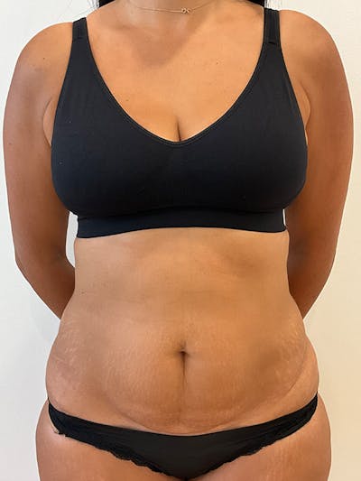 Tummy Tuck Before & After Gallery - Patient 314712 - Image 1