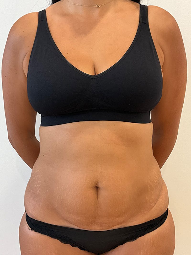 Tummy Tuck Before & After Gallery - Patient 314712 - Image 1