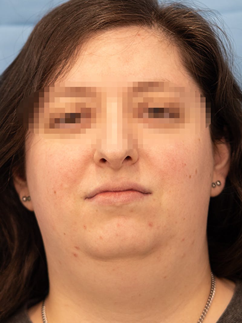 Submental Liposuction Before & After Gallery - Patient 124794 - Image 3