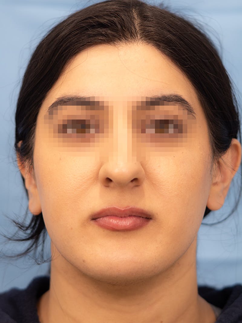 Submental Liposuction Before & After Gallery - Patient 336163 - Image 4
