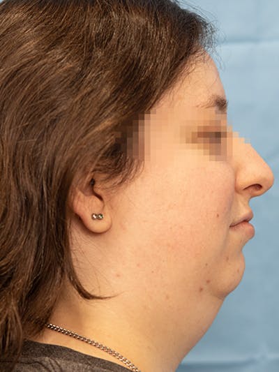 Submental Liposuction Before & After Gallery - Patient 124794 - Image 1