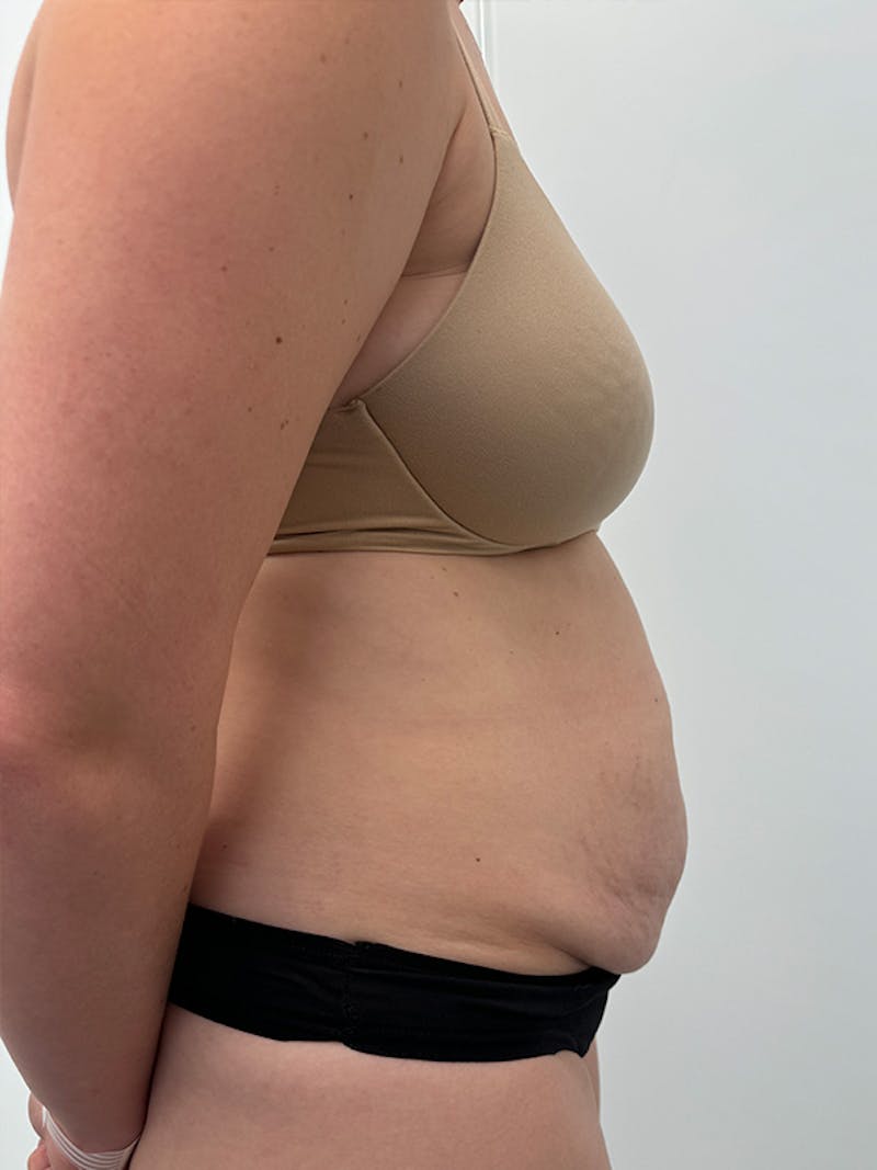 Tummy Tuck Before & After Gallery - Patient 138891 - Image 5