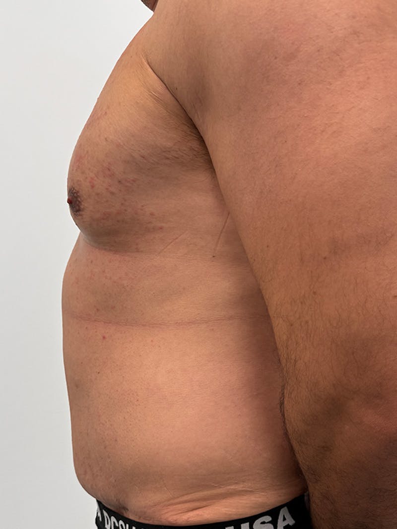 Tummy Tuck Before & After Gallery - Patient 192850 - Image 5