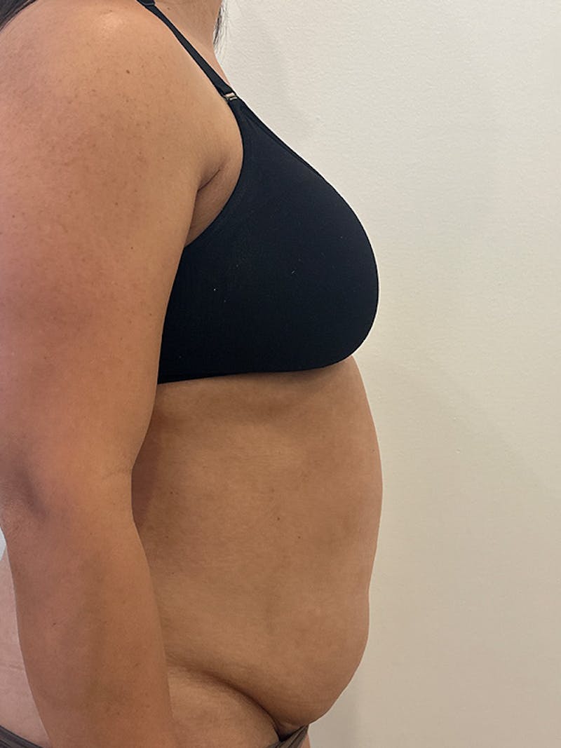Tummy Tuck Before & After Gallery - Patient 174567 - Image 5