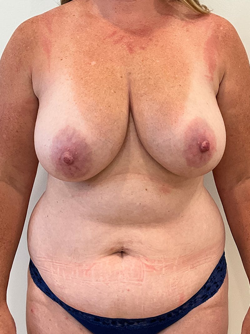 Tummy Tuck Before & After Gallery - Patient 202439 - Image 1