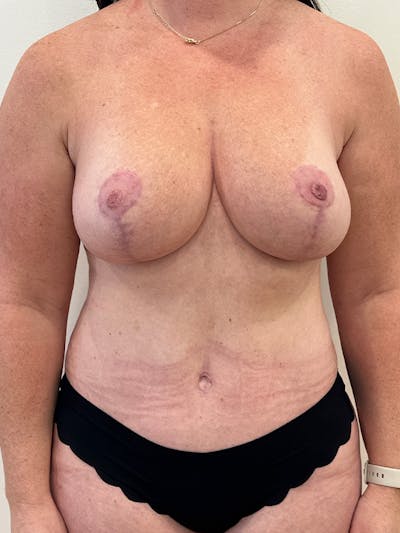Tummy Tuck Before & After Gallery - Patient 202439 - Image 2