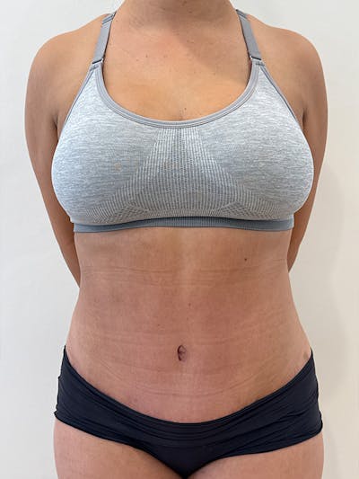 Tummy Tuck Before & After Gallery - Patient 174567 - Image 2
