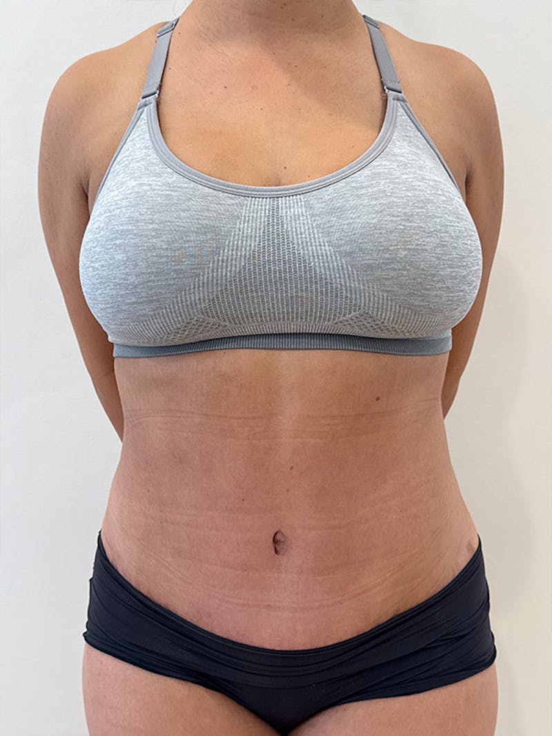 Tummy Tuck Before & After Gallery - Patient 174567 - Image 2
