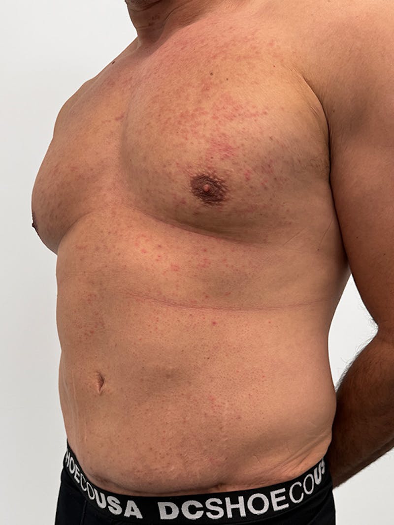 Tummy Tuck Before & After Gallery - Patient 192850 - Image 3