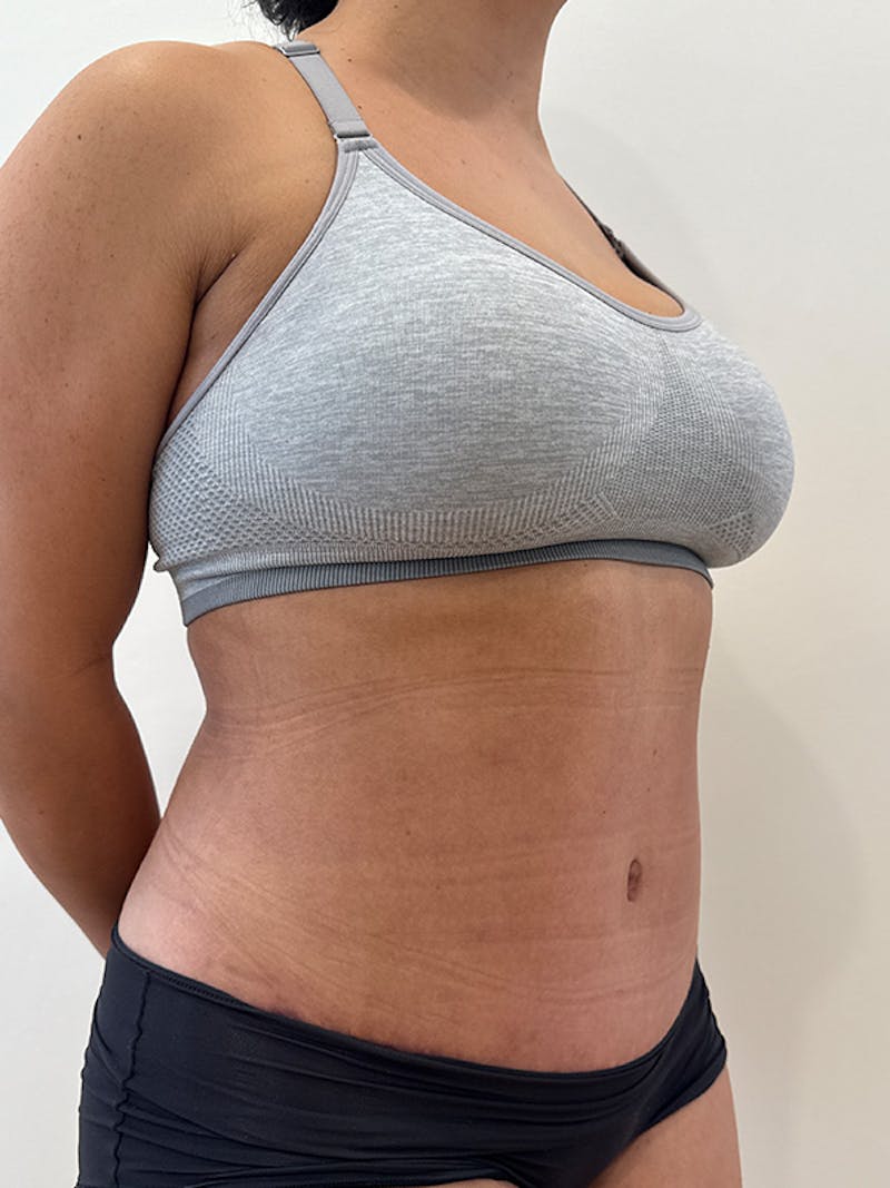 Tummy Tuck Before & After Gallery - Patient 174567 - Image 4