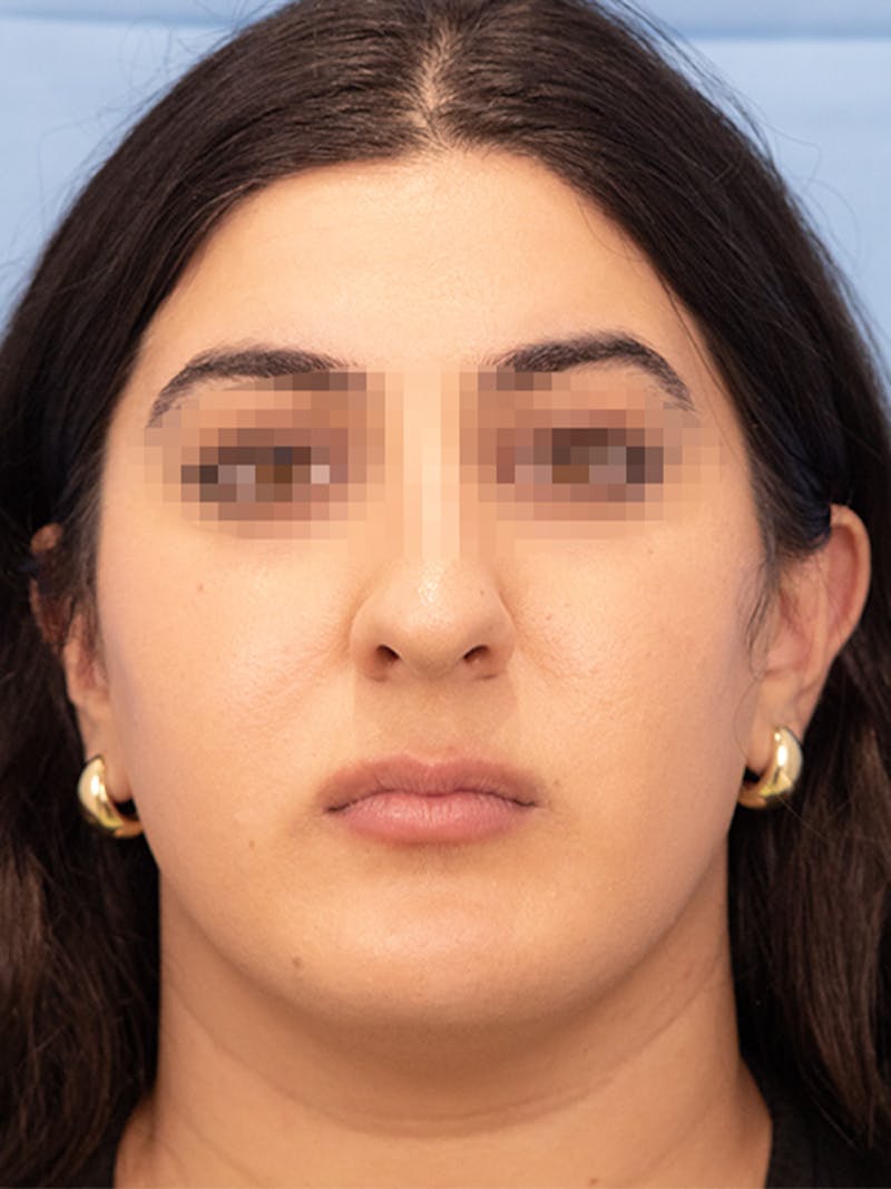 Submental Liposuction Before & After Gallery - Patient 336163 - Image 3
