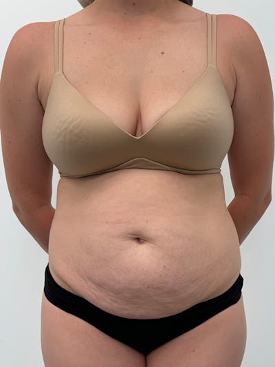 Tummy Tuck Before & After Gallery - Patient 138891 - Image 1
