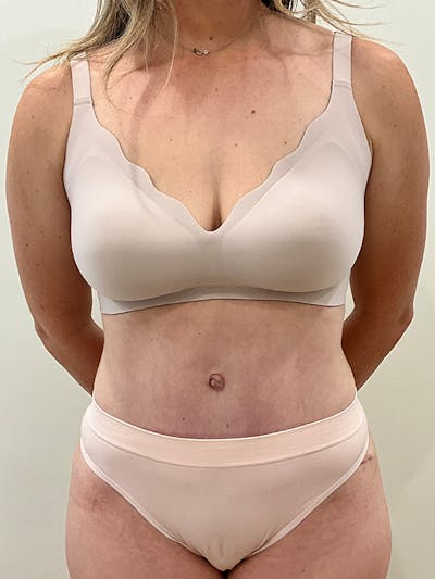 Tummy Tuck Before & After Gallery - Patient 138891 - Image 2