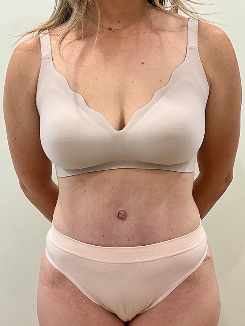 Tummy Tuck Before & After Gallery - Patient 138891 - Image 2