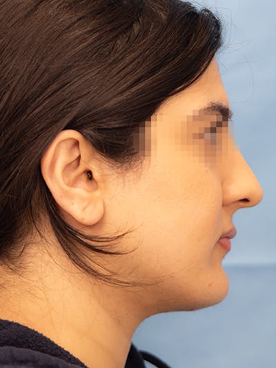 Submental Liposuction Before & After Gallery - Patient 336163 - Image 2