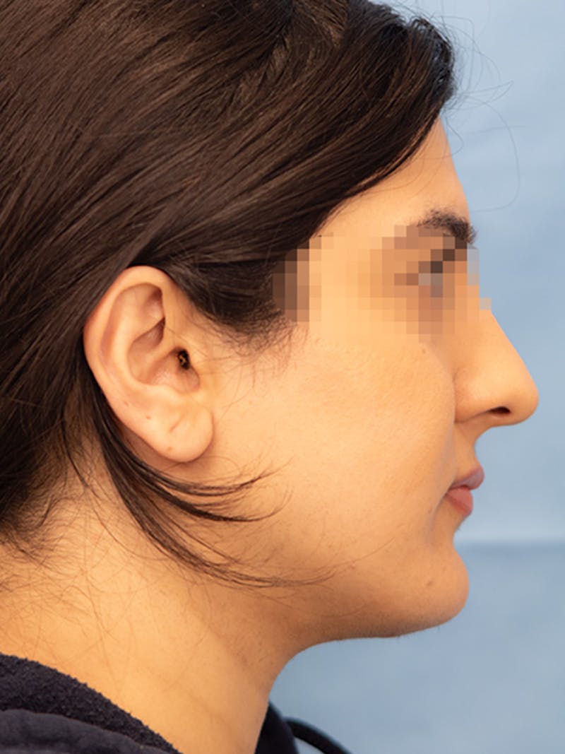 Submental Liposuction Before & After Gallery - Patient 336163 - Image 2
