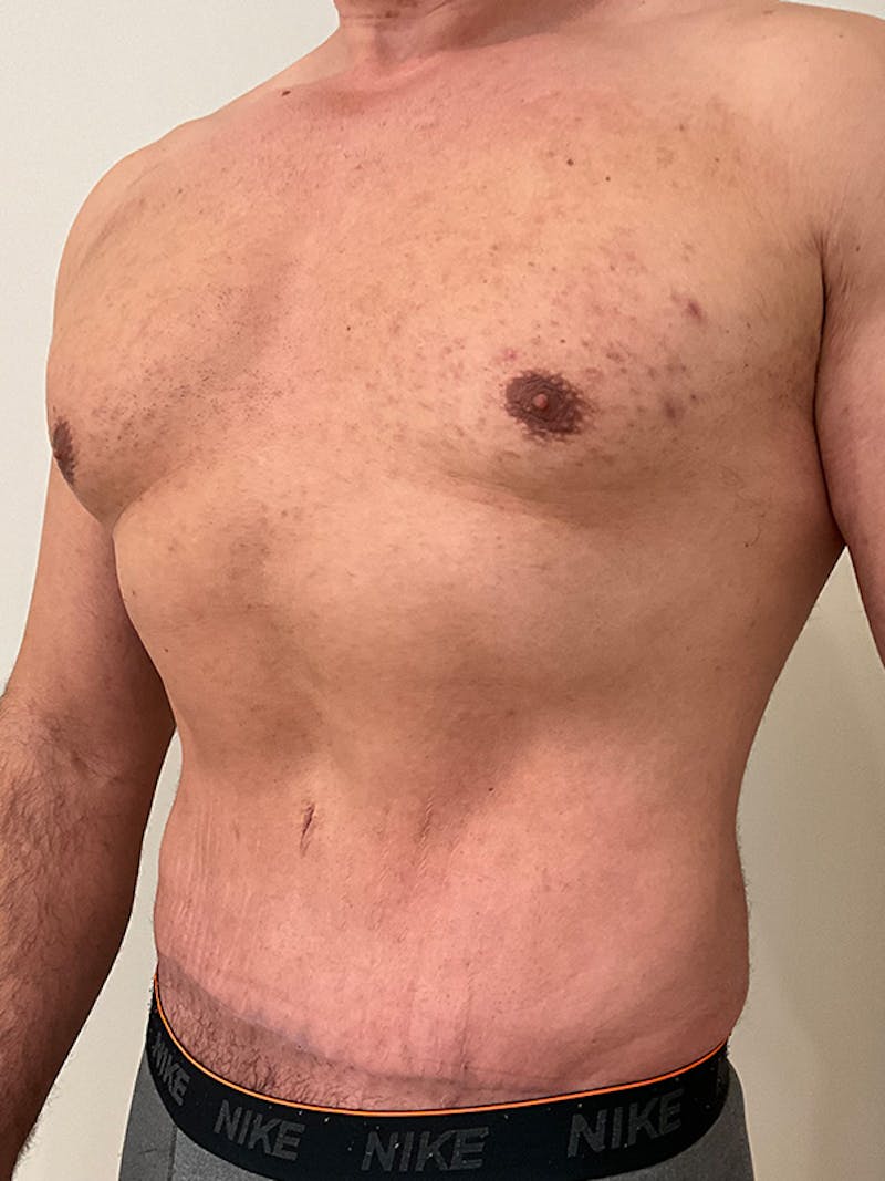 Tummy Tuck Before & After Gallery - Patient 192850 - Image 4
