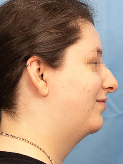 Submental Liposuction Before & After Gallery - Patient 124794 - Image 2