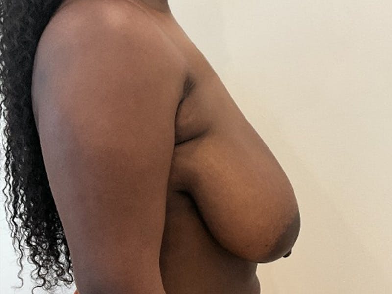 Liposuction Before & After Gallery - Patient 265816 - Image 5