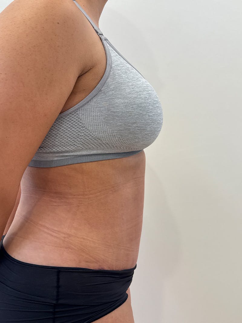 Tummy Tuck Before & After Gallery - Patient 174567 - Image 6