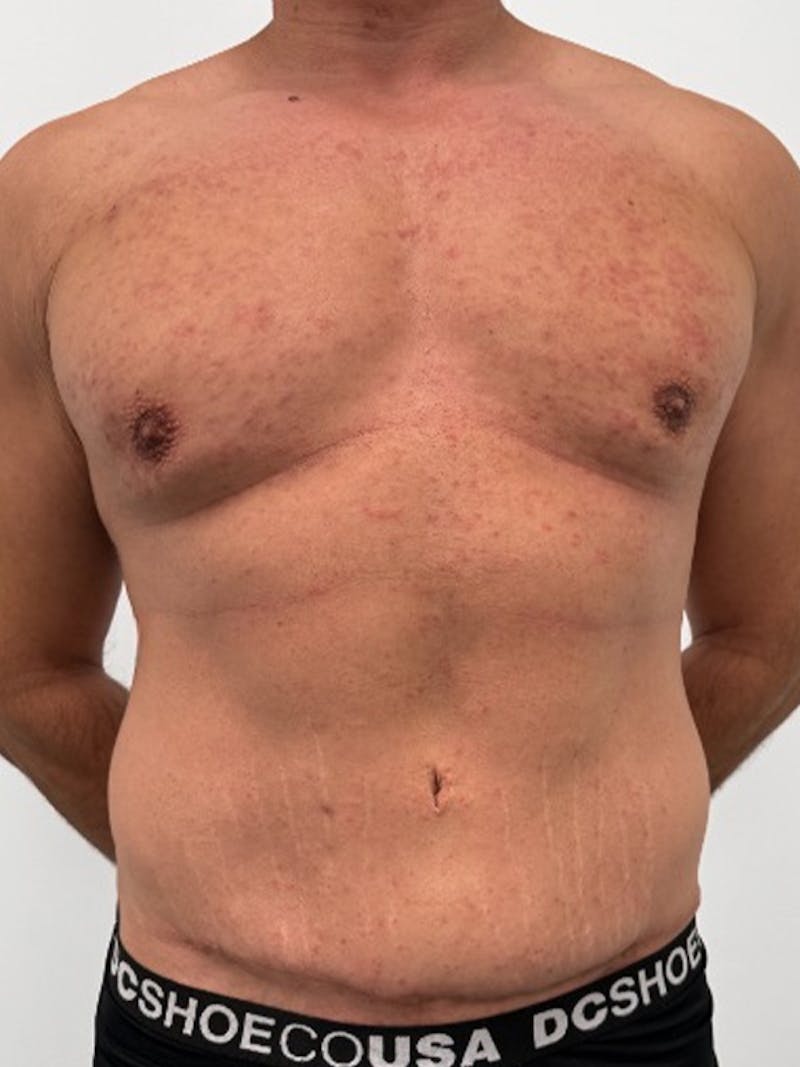 Tummy Tuck Before & After Gallery - Patient 192850 - Image 1