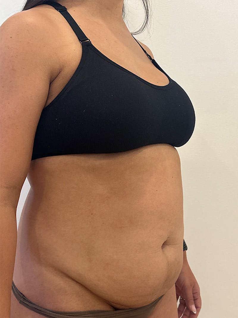 Tummy Tuck Before & After Gallery - Patient 174567 - Image 3