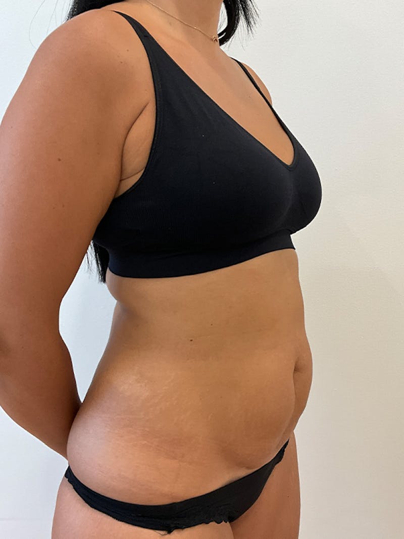 Tummy Tuck Before & After Gallery - Patient 314712 - Image 3