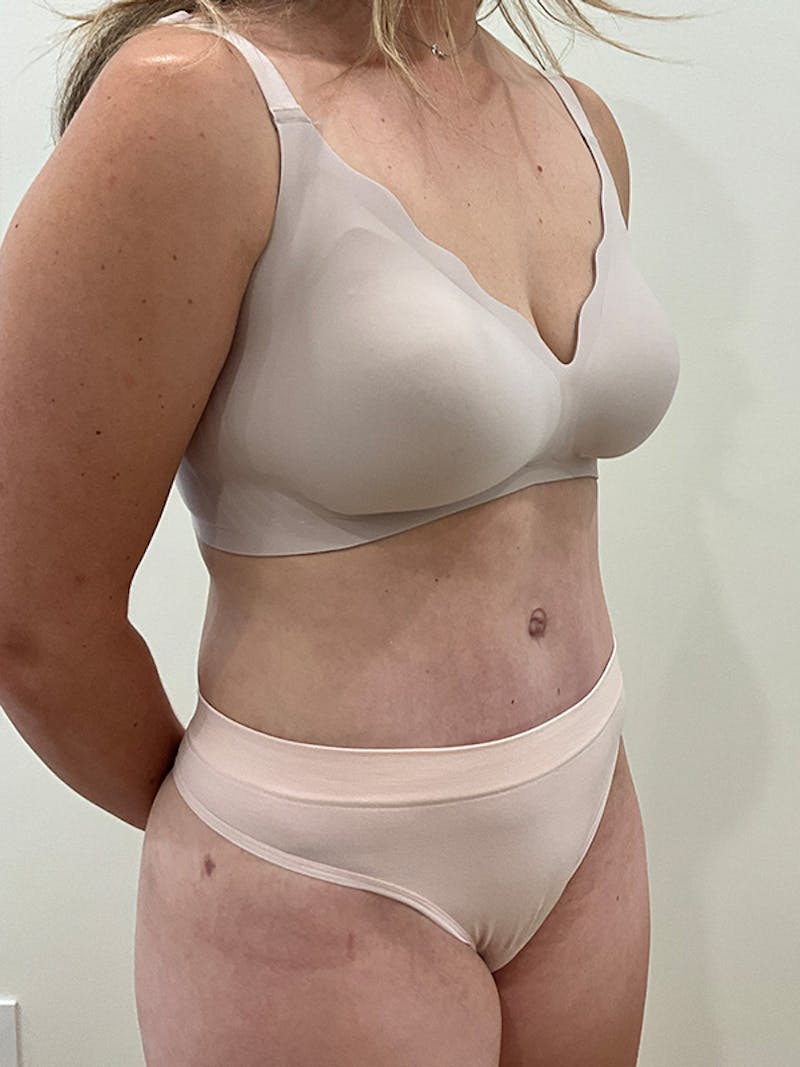 Tummy Tuck Before & After Gallery - Patient 138891 - Image 4